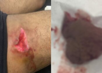 Homem é atacado por piranhas e leva mordida profunda na perna, em Itaituba