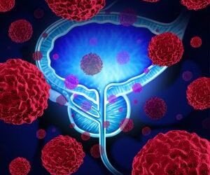 Câncer de próstata: na Região Norte do país, o Pará lidera em número de casos e Roraima, em crescimento, na comparação entre os anos 2022 e 2021