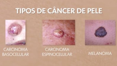 tipos de cancer de pele