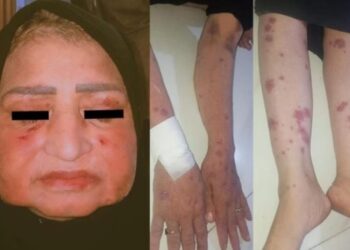 Mulher chora lgrimas de pus aps tomar medicamento