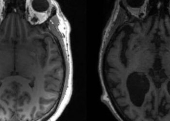 Cientistas fazem descoberta sobre estgio inicial do Alzheimer