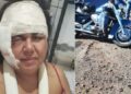 Empresria leva 60 pontos no rosto e quebra brao em acidente
