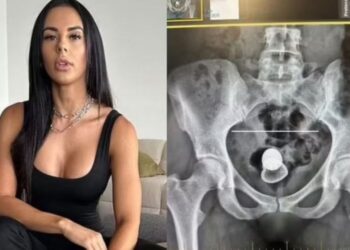 Atriz diz que ficou com plug anal preso no corpo