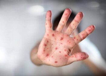 Pará completa dois anos sem registrar casos de sarampo