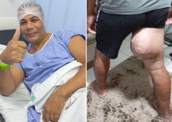 Homem com tumor gigante vai para a cirurgia, mas procedimento não acontece: 'Frustração'
