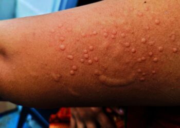 Itaituba não registra casos de Mpox, mas mantém alerta e protocolo de prevenção