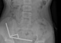 Adolescente perde parte do intestino aps engolir mais de 80 ims | FOLHAMAX