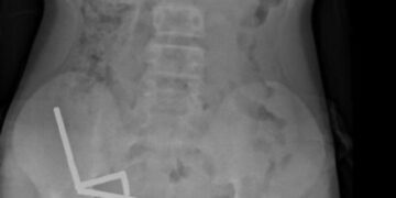 Adolescente perde parte do intestino aps engolir mais de 80 ims | FOLHAMAX
