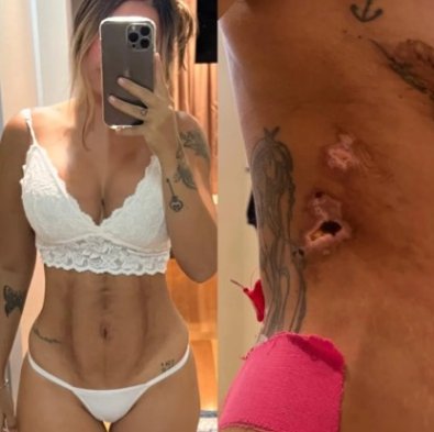 DEFORMACAO LIPO1.jpg