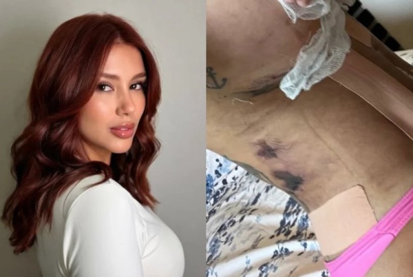 Influencer acusa clnica esttica de deformar seu corpo | FOLHAMAX