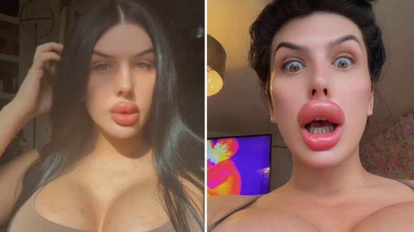 Modelo banida de clnicas aps risco de rompimento dos lbios | FOLHAMAX