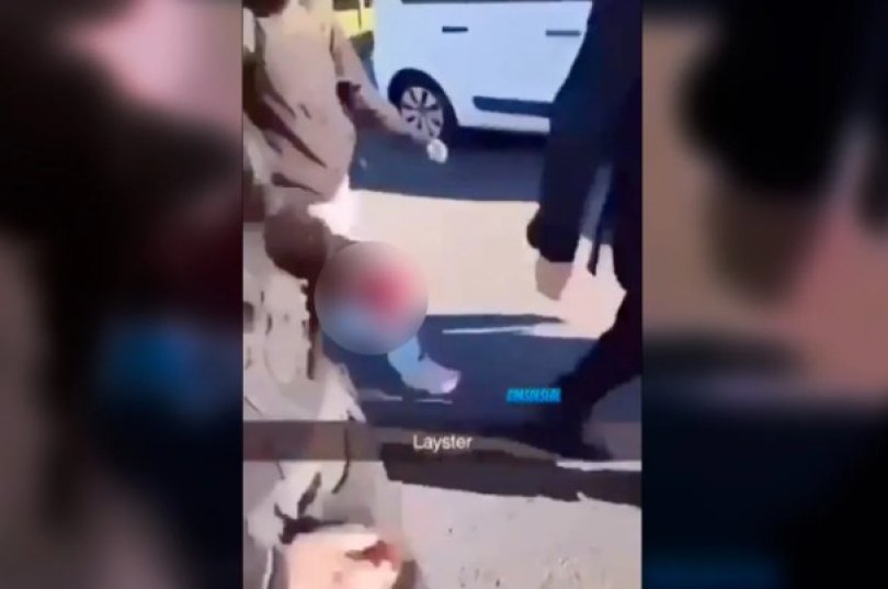 Estudante de 15 anos tem mo arrancada por exploso de granada | FOLHAMAX